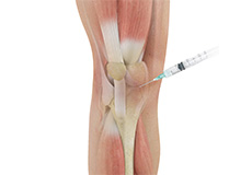 Cortisone Injection