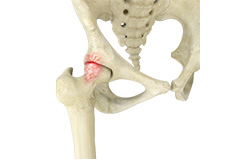 Femoroacetabular Impingement