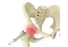Hip Injections
