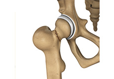 Outpatient Hip Replacement