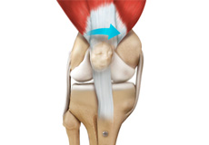 Patellofemoral Knee Replacement