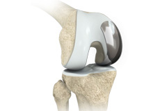 Unicompartmental Knee Replacement